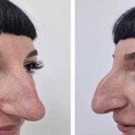 «Rhinoplasty changed her whole life!»: The way this lady transformed after rhinoplasty will surprise everyone.