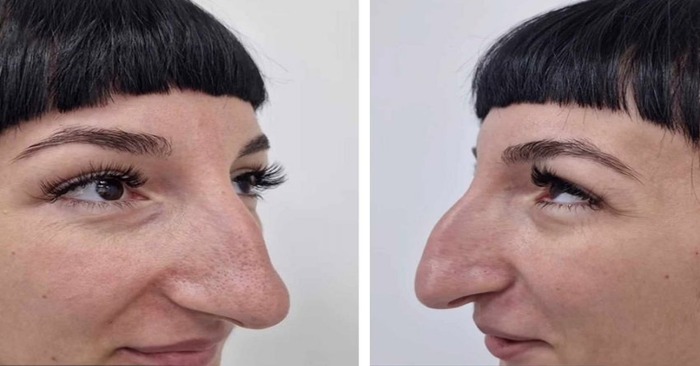 «Rhinoplasty changed her whole life!»: The way this lady transformed after rhinoplasty will surprise everyone.