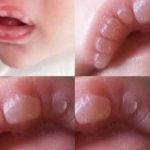 HT10. If your baby has these marks it means