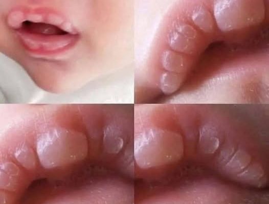 HT10. If your baby has these marks it means