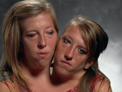 Living a conjoined life…!!